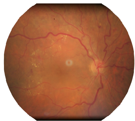 Tudo que você precisa saber sobre Retinopatia Diabética Sol