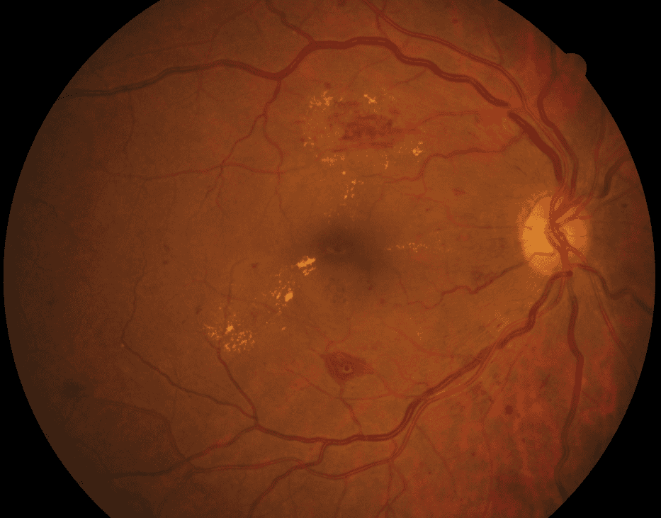 retina