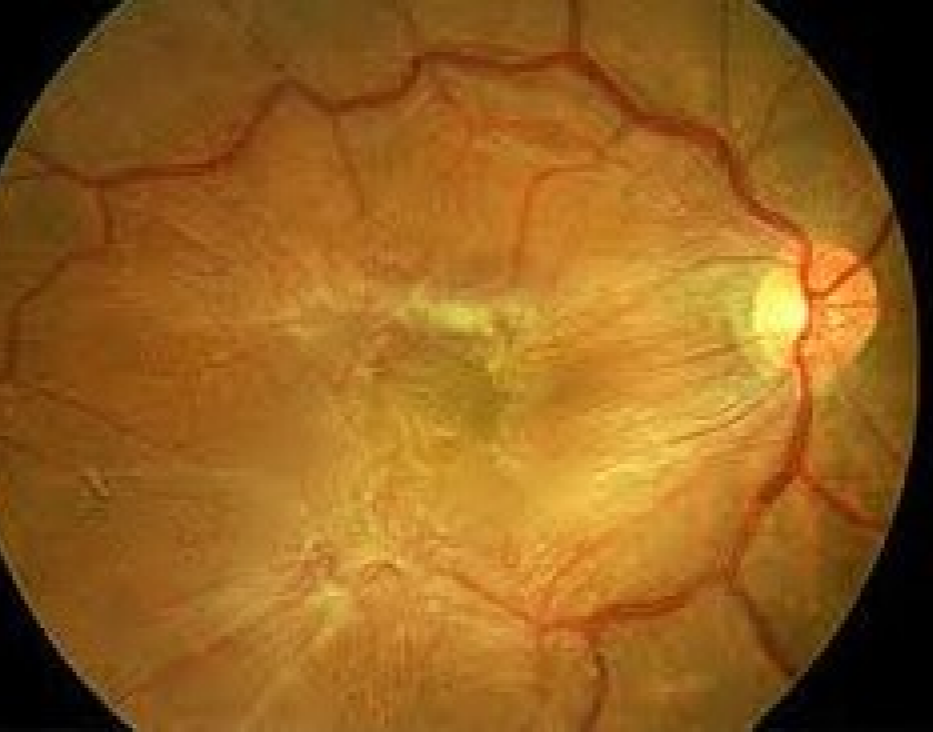 retina