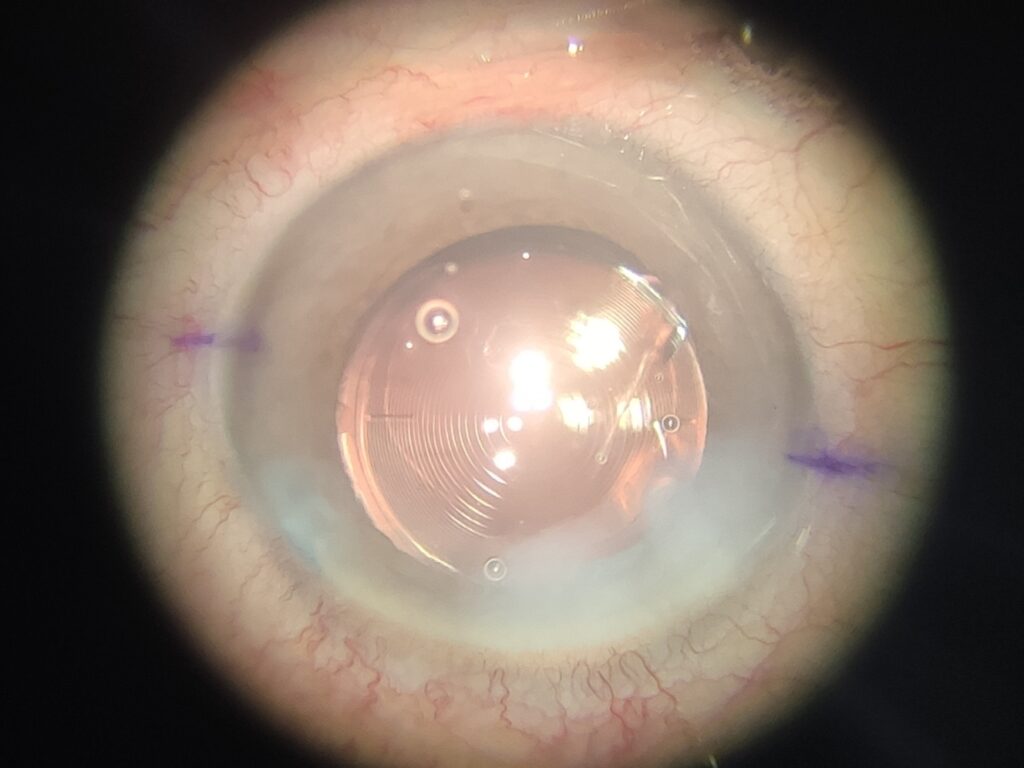 lente intraocular